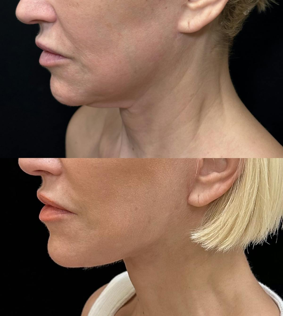Necklift Before & After Gallery - Patient 199079 - Image 3