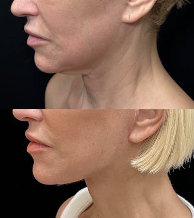Deep Plane Facelift Before & After Gallery - Patient 147317 - Image 3
