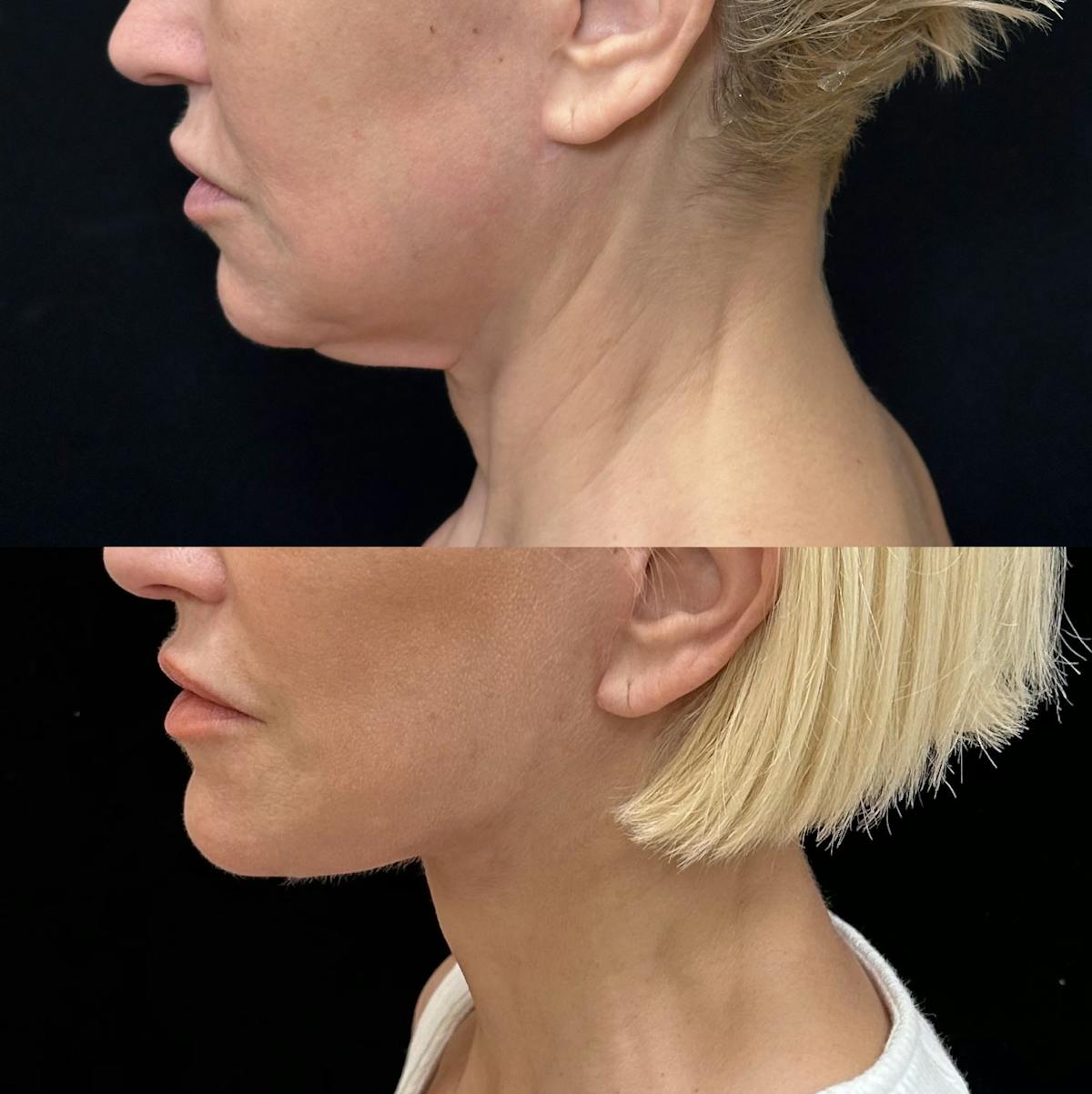 Necklift Before & After Gallery - Patient 199079 - Image 2