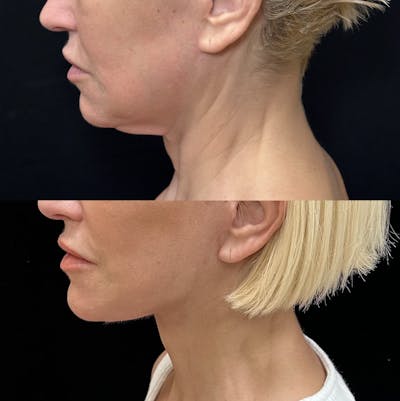 Deep Plane Facelift Before & After Gallery - Patient 147317 - Image 2