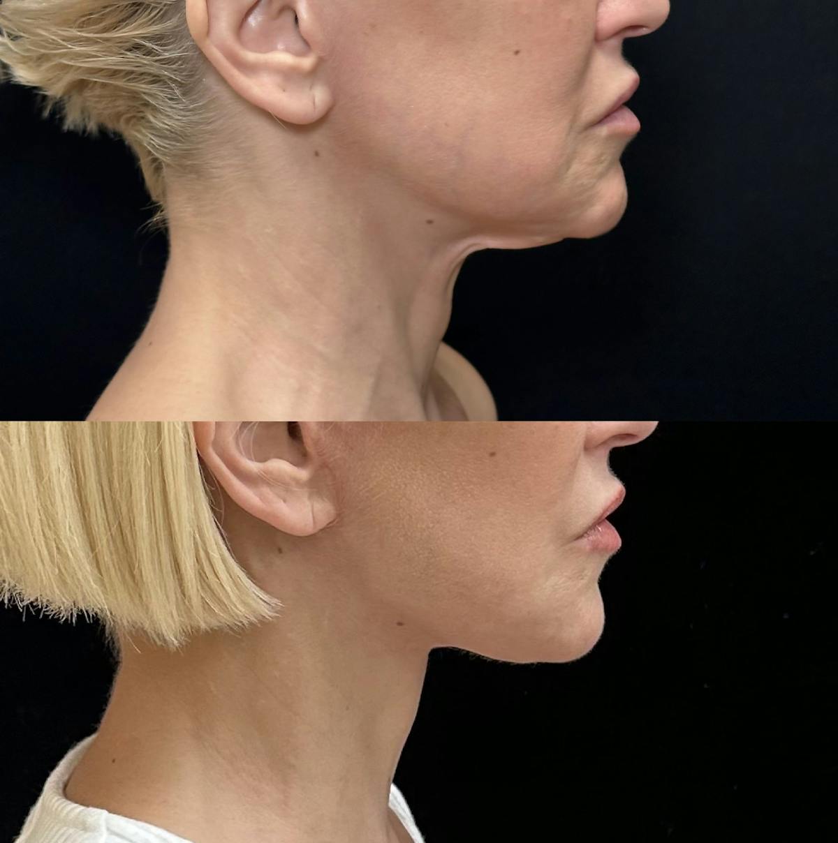 Necklift Before & After Gallery - Patient 199079 - Image 4