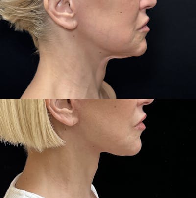 Deep Plane Facelift Before & After Gallery - Patient 147317 - Image 4