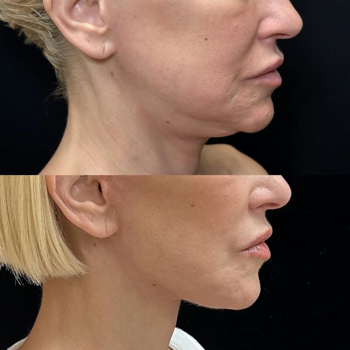 Necklift Before & After Gallery - Patient 199079 - Image 1