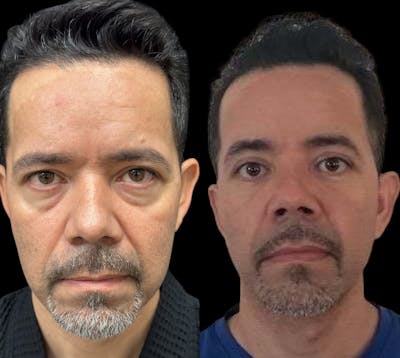 Facial Fat Transfer Before & After Gallery - Patient 401168 - Image 1