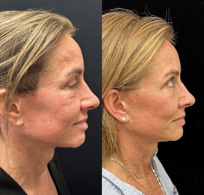 Facial Fat Transfer Before & After Gallery - Patient 237015 - Image 3