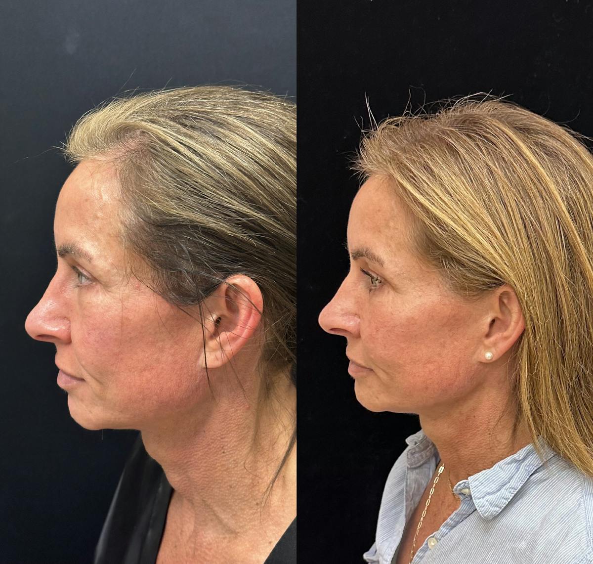  Facial Fat Transfer Before & After Gallery - Patient 237015 - Image 4