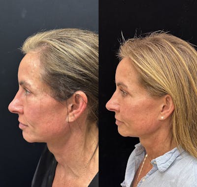 Facial Fat Transfer Before & After Gallery - Patient 237015 - Image 4