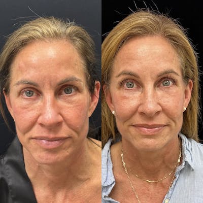 Facial Fat Transfer Before & After Gallery - Patient 237015 - Image 2