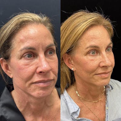 Facial Fat Transfer Before & After Gallery - Patient 237015 - Image 5