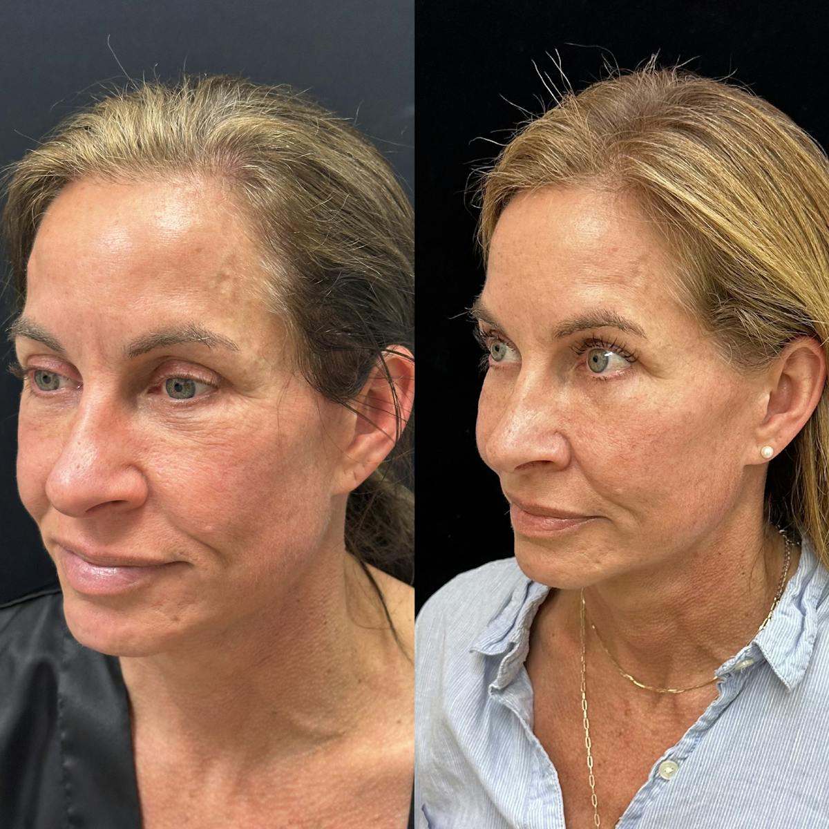  Facial Fat Transfer Before & After Gallery - Patient 237015 - Image 1