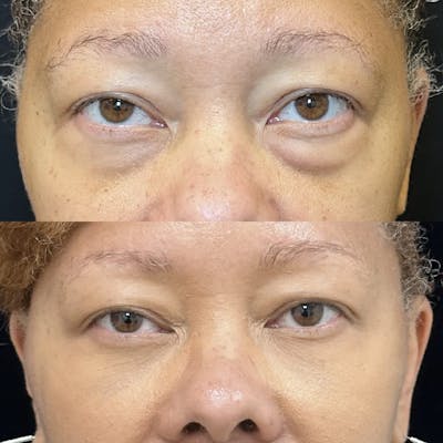 Lower Blepharoplasty Before & After Gallery - Patient 363949 - Image 2
