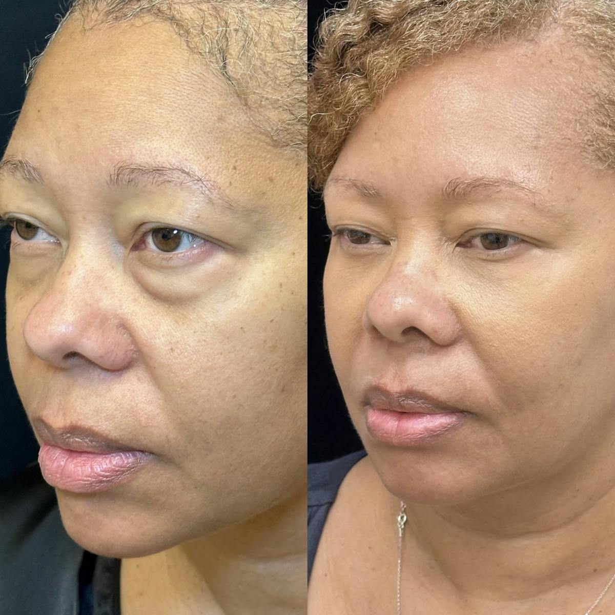 Lower Blepharoplasty Before & After Gallery - Patient 363949 - Image 1