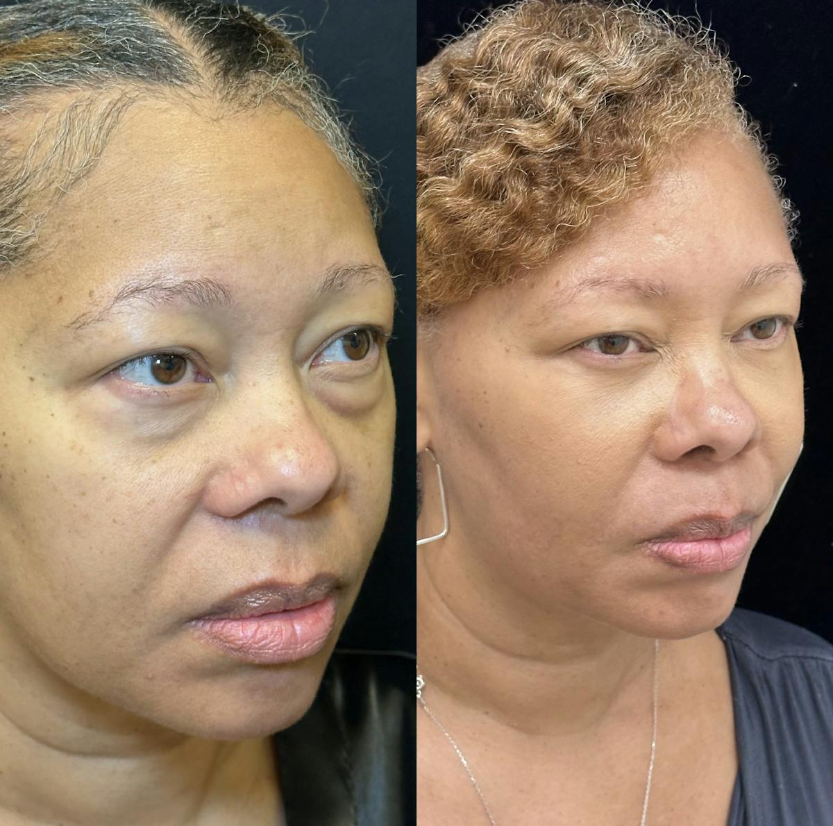 Lower Blepharoplasty Before & After Gallery - Patient 363949 - Image 4