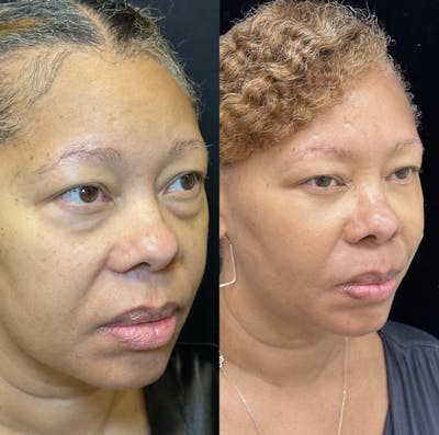 Lower Blepharoplasty Before & After Gallery - Patient 363949 - Image 4