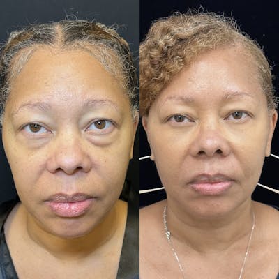 Lower Blepharoplasty Before & After Gallery - Patient 363949 - Image 3