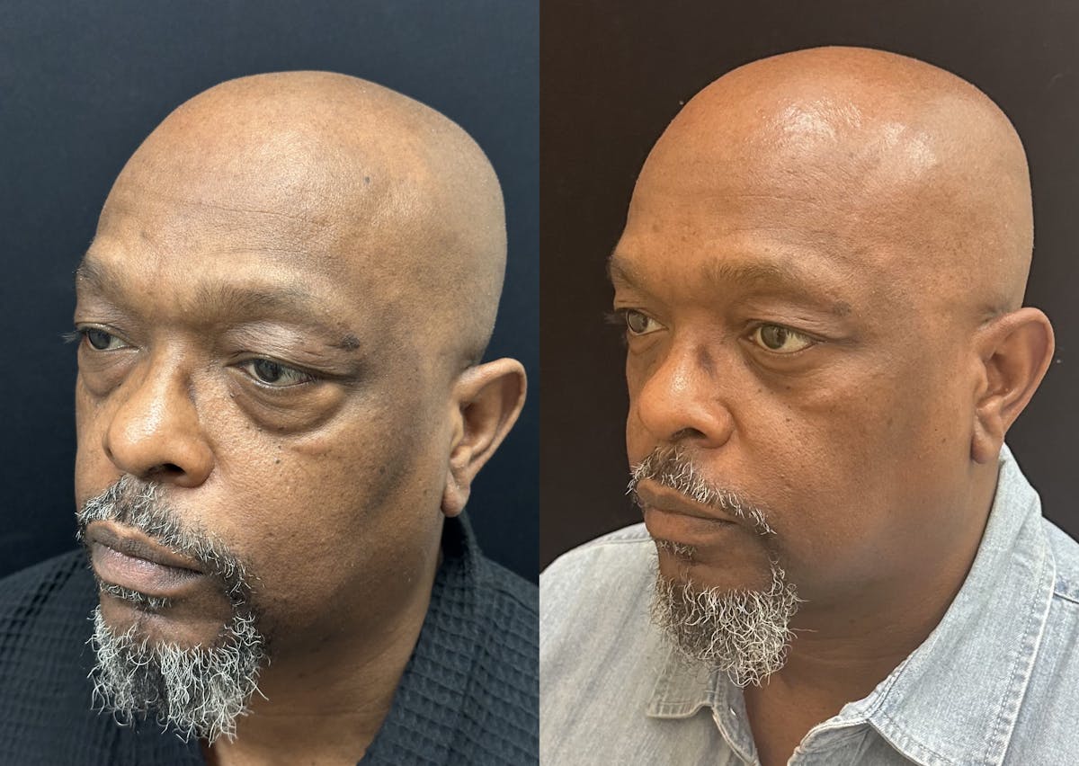 Lower Blepharoplasty Before & After Gallery - Patient 214517 - Image 2