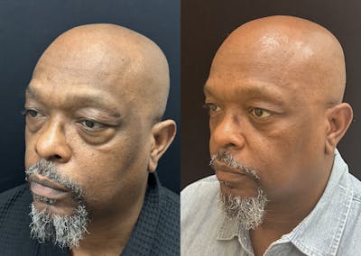 Lower Blepharoplasty Before & After Gallery - Patient 214517 - Image 2