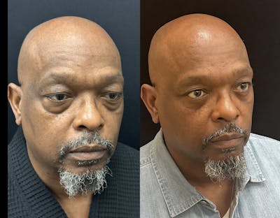 Lower Blepharoplasty Before & After Gallery - Patient 214517 - Image 3