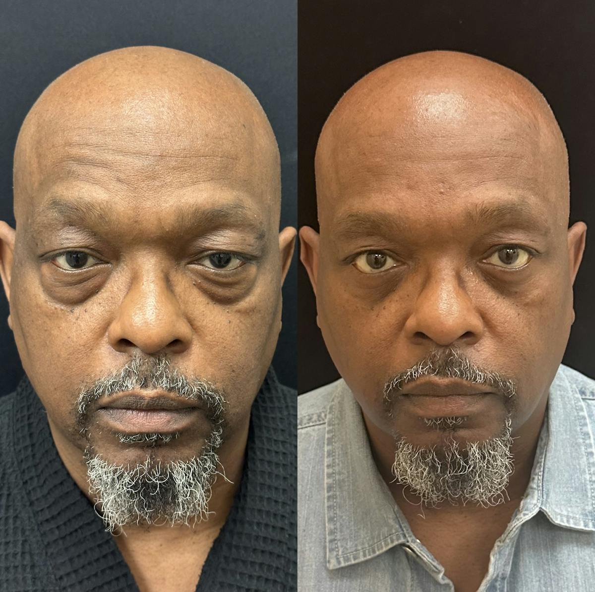 Lower Blepharoplasty Before & After Gallery - Patient 214517 - Image 1
