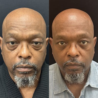 Lower Blepharoplasty Before & After Gallery - Patient 214517 - Image 1