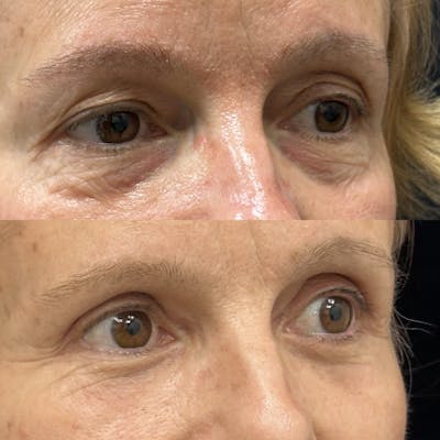 Lower Blepharoplasty Before & After Gallery - Patient 157995 - Image 3