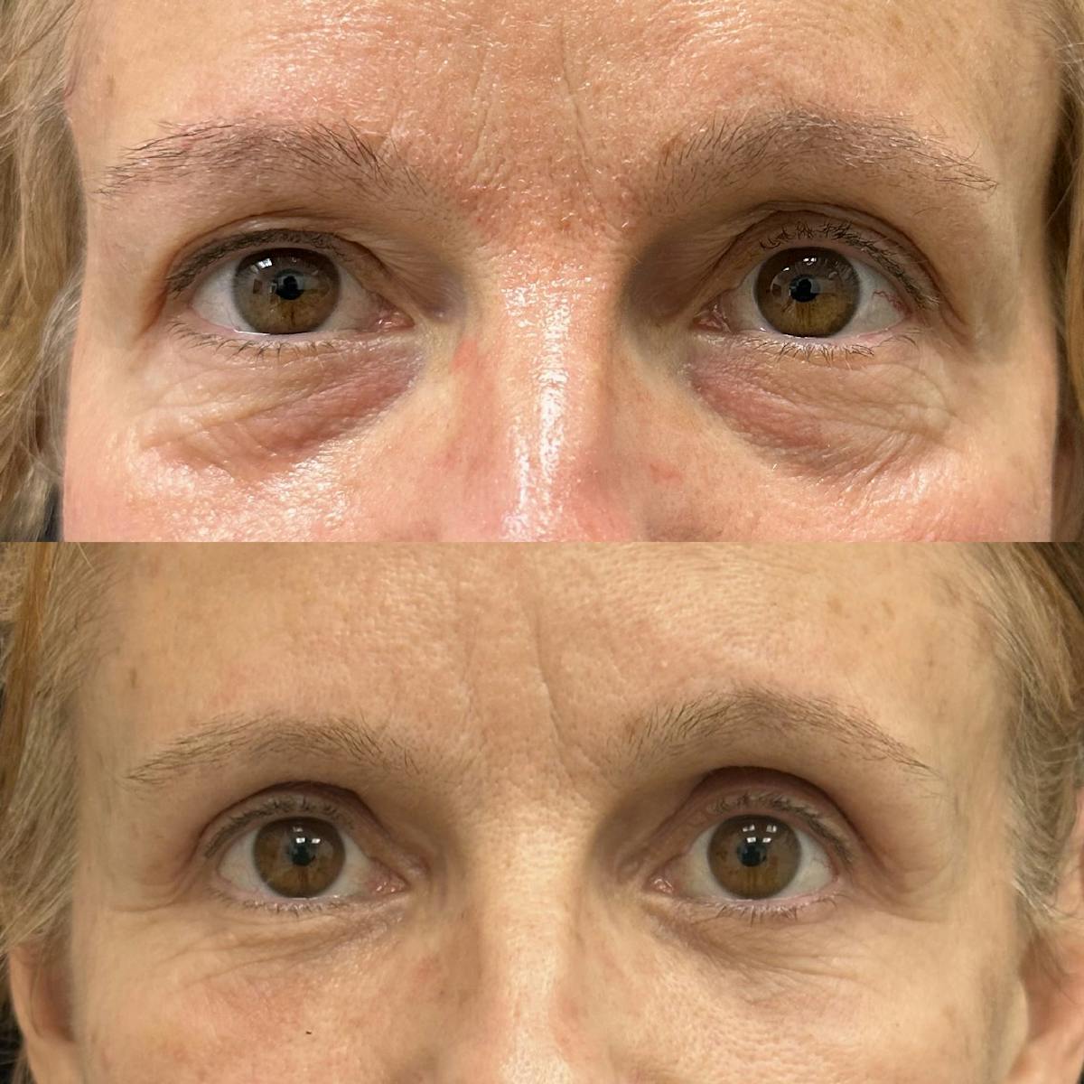  Upper Blepharoplasty Before & After Gallery - Patient 861635 - Image 5