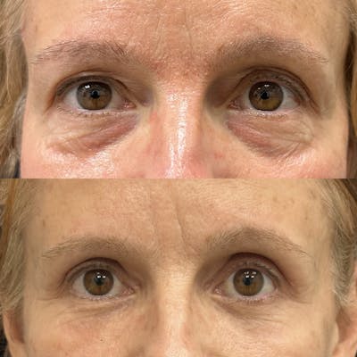 Lower Blepharoplasty Before & After Gallery - Patient 157995 - Image 5