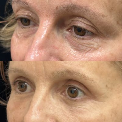 Lower Blepharoplasty Before & After Gallery - Patient 157995 - Image 2