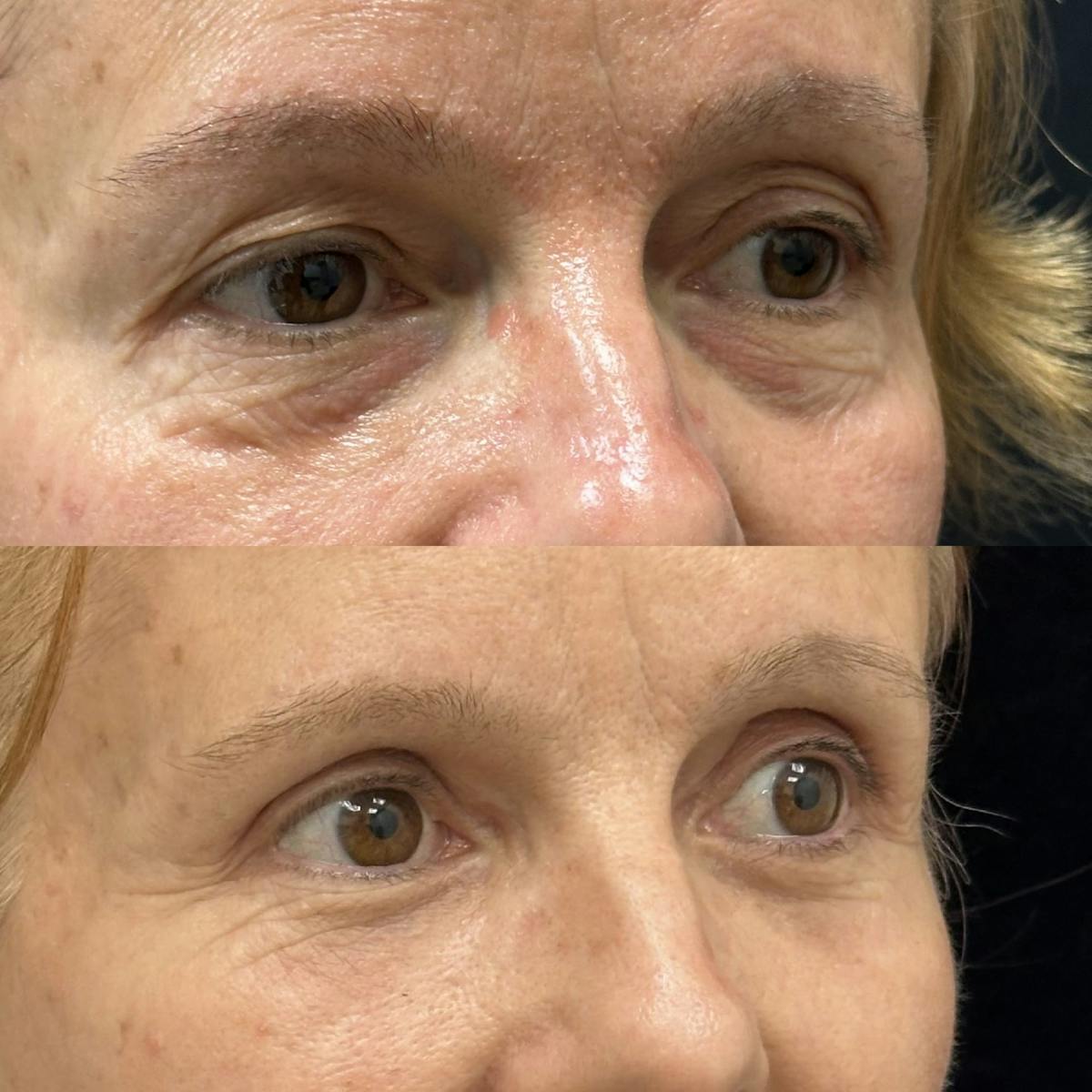  Upper Blepharoplasty Before & After Gallery - Patient 861635 - Image 4