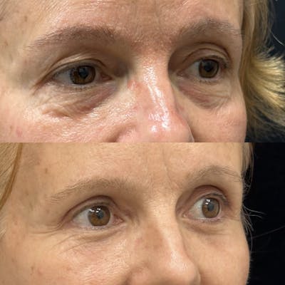 Lower Blepharoplasty Before & After Gallery - Patient 157995 - Image 4