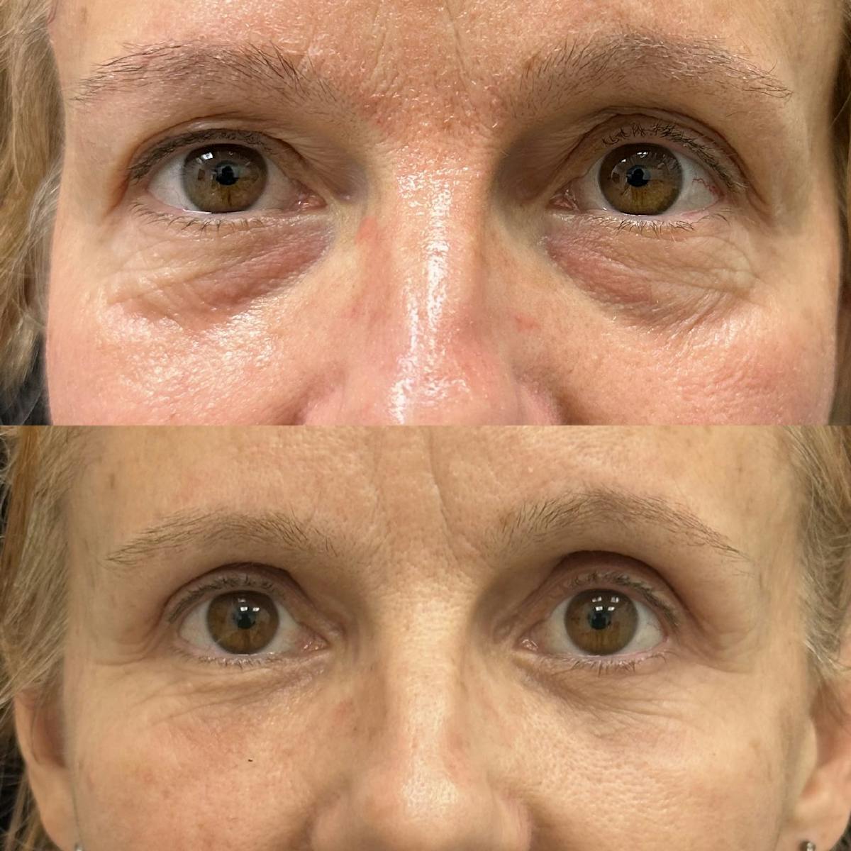  Upper Blepharoplasty Before & After Gallery - Patient 861635 - Image 1