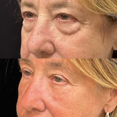 Lower Blepharoplasty Before & After Gallery - Patient 122972 - Image 2