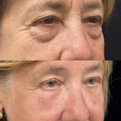 Lower Blepharoplasty Before & After Gallery - Patient 122972 - Image 3