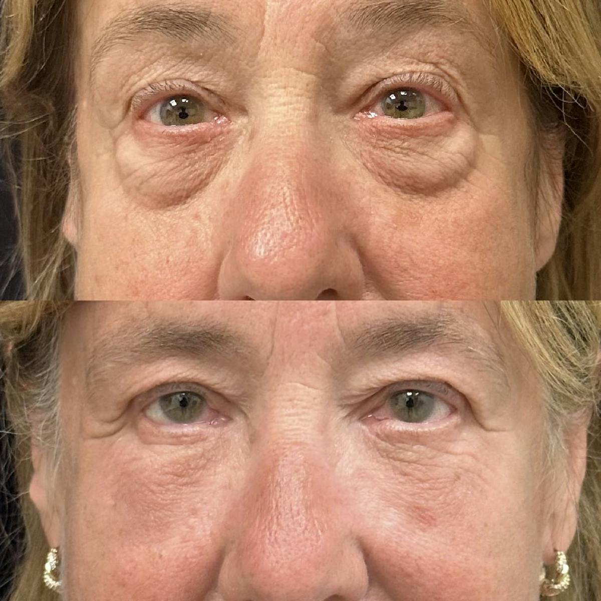 Lower Blepharoplasty Before & After Gallery - Patient 122972 - Image 1