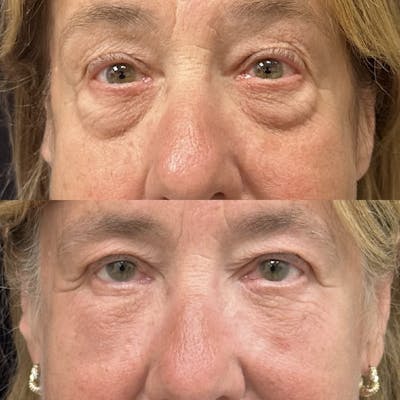 Facial Fat Transfer Before & After Gallery - Patient 232801 - Image 1