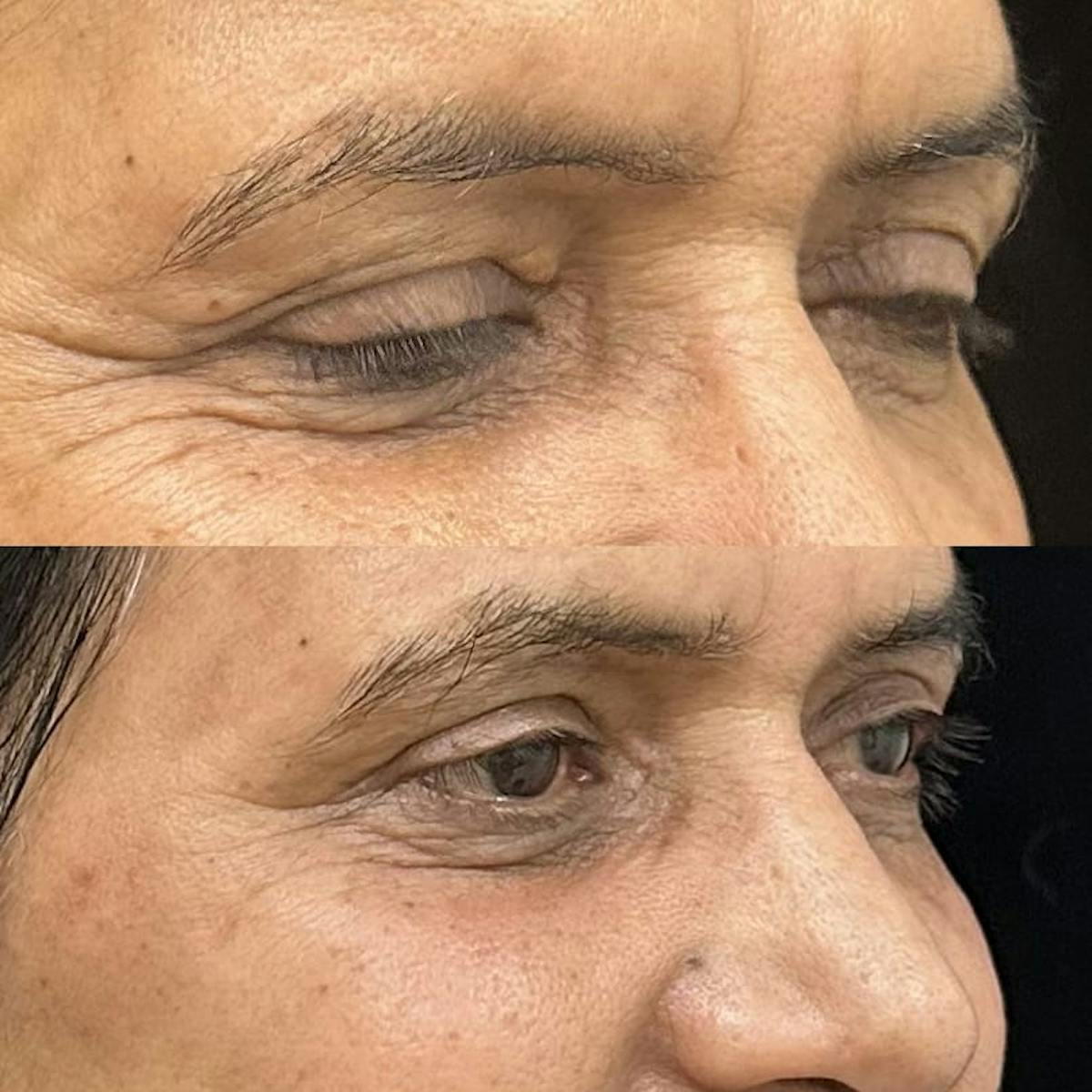  Upper Blepharoplasty Before & After Gallery - Patient 265798 - Image 1
