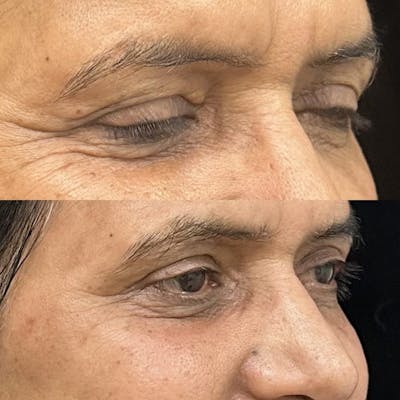 Upper Blepharoplasty Before & After Gallery - Patient 265798 - Image 1