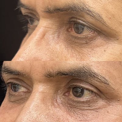 Upper Blepharoplasty Before & After Gallery - Patient 265798 - Image 3