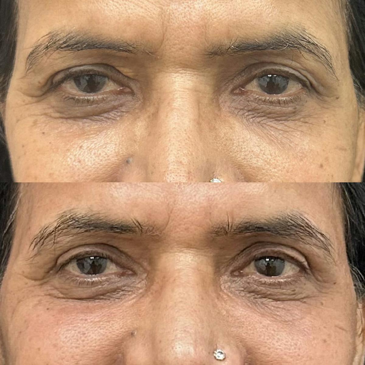  Upper Blepharoplasty Before & After Gallery - Patient 265798 - Image 2