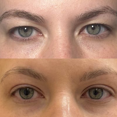 Upper Blepharoplasty Before & After Gallery - Patient 317737 - Image 3