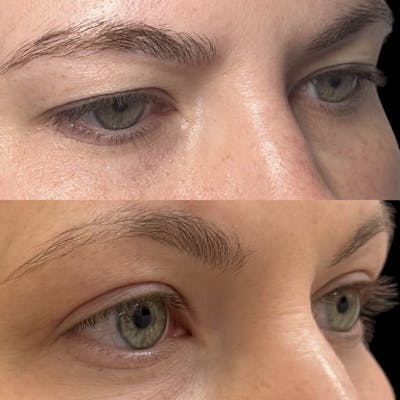 Upper Blepharoplasty Before & After Gallery - Patient 317737 - Image 2