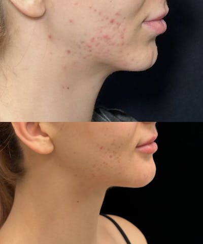 Necklift Before & After Gallery - Patient 266847 - Image 2