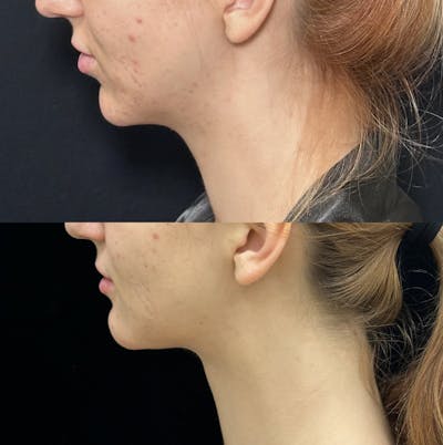 Necklift Before & After Gallery - Patient 266847 - Image 5