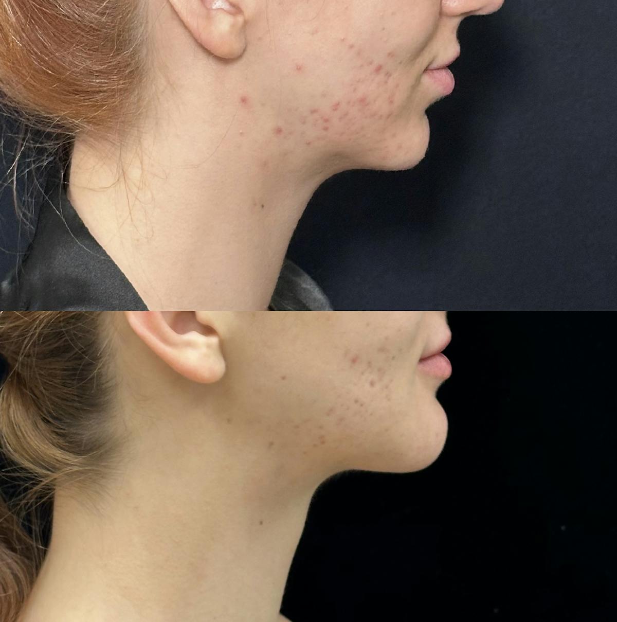 Necklift Before & After Gallery - Patient 266847 - Image 1
