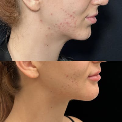 Necklift Before & After Gallery - Patient 266847 - Image 3