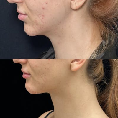 Necklift Before & After Gallery - Patient 266847 - Image 4