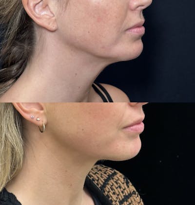 Necklift Before & After Gallery - Patient 155780 - Image 3
