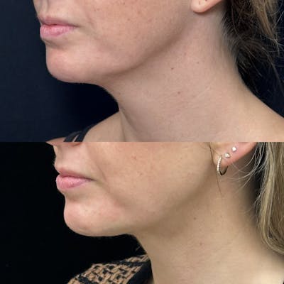 Necklift Before & After Gallery - Patient 155780 - Image 4