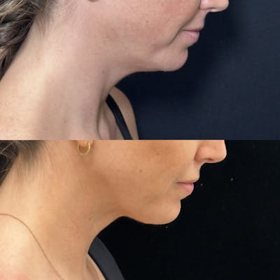 Necklift Before & After Gallery - Patient 155780 - Image 2