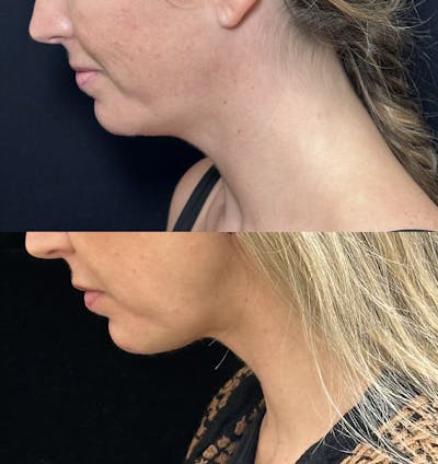 Necklift Before & After Gallery - Patient 155780 - Image 5